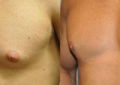 Gynaecomastia surgery outcomes: Before and after images