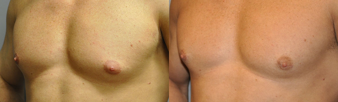 Gynaecomastia surgery outcomes: Before and after images