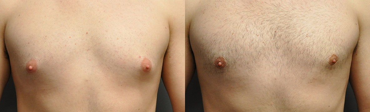 Chest contouring results: Visual evidence of Gynaecomastia effects