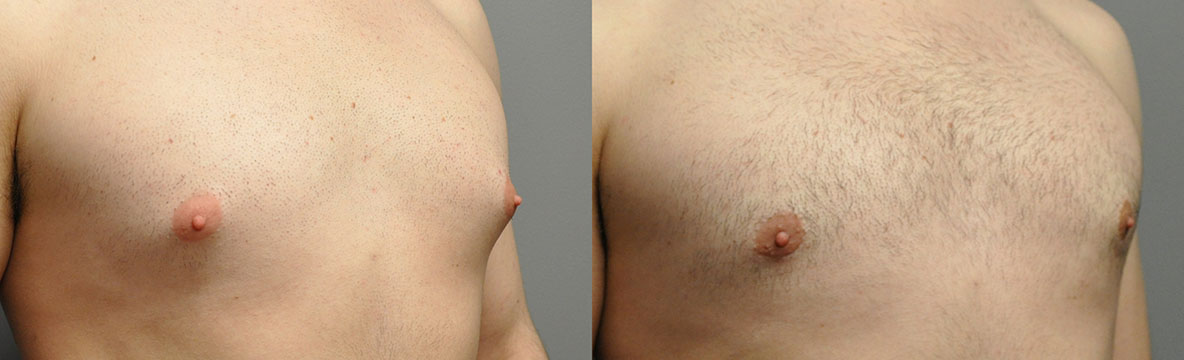 Gynaecomastia transformation: Dramatic changes in chest appearance