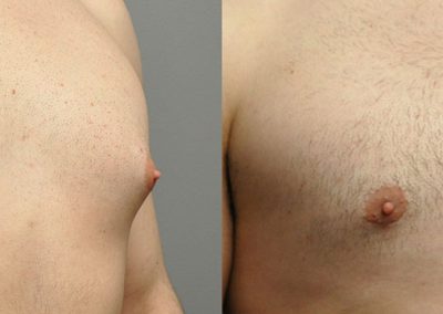 Gynaecomastia surgery transformation: Dramatic chest contour changes