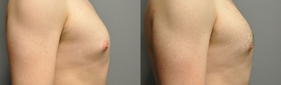 Visible changes in chest profile: Gynaecomastia before and after