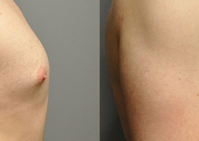 Visible changes in chest appearance: Gynaecomastia before and after