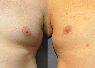 Gynaecomastia treatment results: Visual comparison of pre and post-surgery