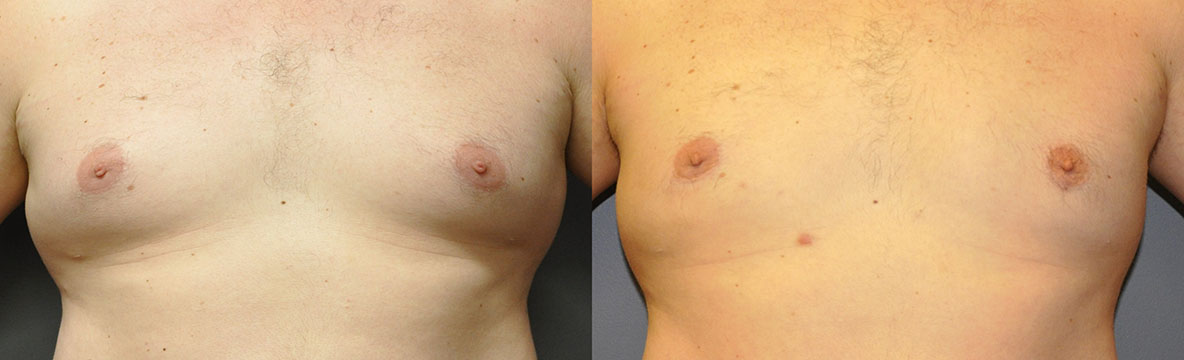 Gynaecomastia correction outcomes: Before and after chest contouring