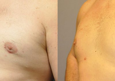 Before and after Gynaecomastia surgery: Transformative chest contouring