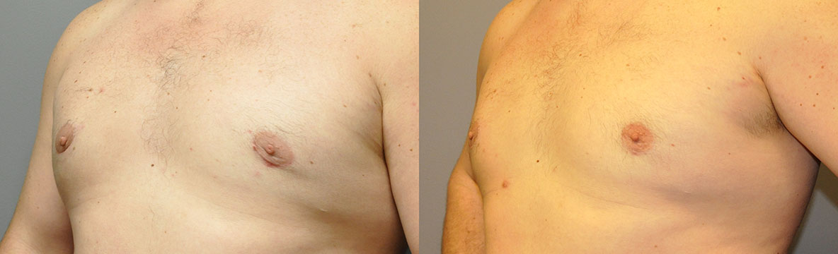 Before and after Gynaecomastia surgery: Transformative chest contouring