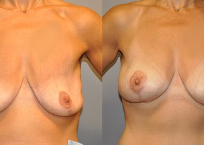 Breast reshaping outcomes: Visual evidence of Mastopexy effects