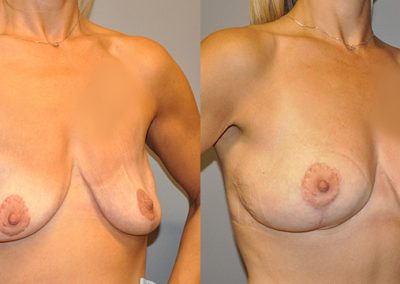 Mastopexy transformation: Dramatic changes in breast appearance