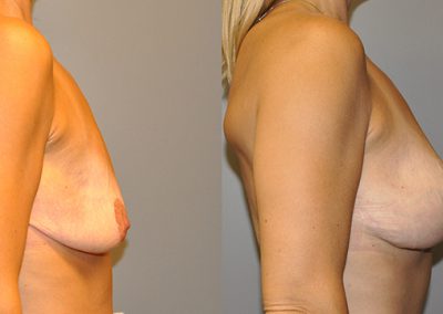 Visible changes in breast profile: Mastopexy before and after