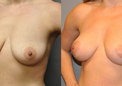 Breast Lift outcomes: Visual comparison of pre and post-surgery