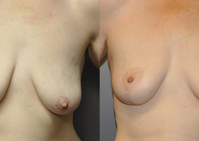Natural-looking breast lift: Mastopexy transformation