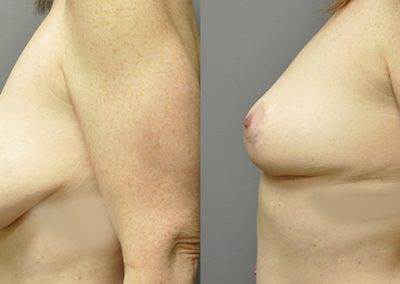 Mastopexy transformation: Before and after breast lift procedure
