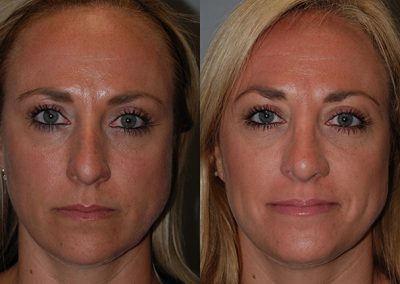 Nasal reshaping: Before and after Septorhinoplasty surgery