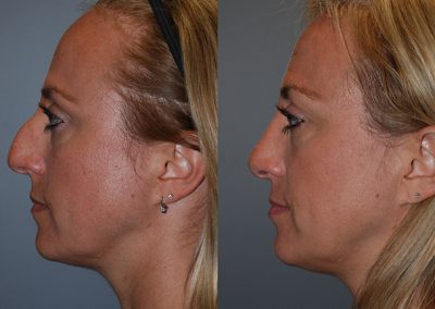 Improved nasal breathing: Septorhinoplasty success