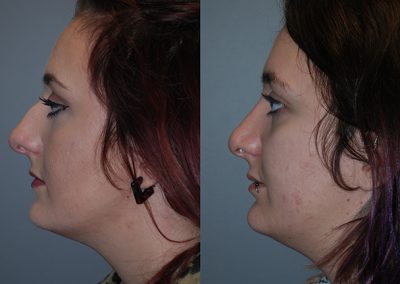 Enhanced nasal function and aesthetics: Septorhinoplasty outcomes