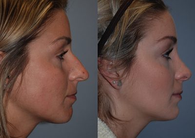 Before and after Septorhinoplasty: Transformative changes in nasal appearance
