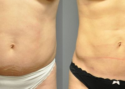 Body contouring results: Before and after Liposuction procedure
