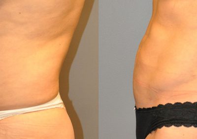 Visible changes in body shape: Liposuction before and after