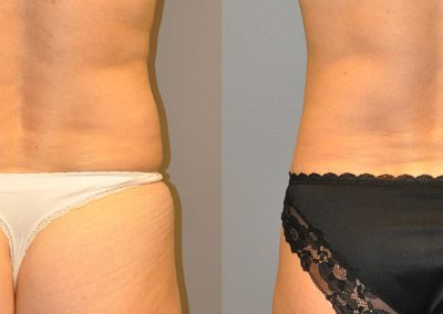 Before and after fat removal: Liposuction success