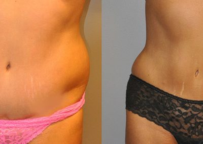 Body sculpting with Liposuction: Transformational results