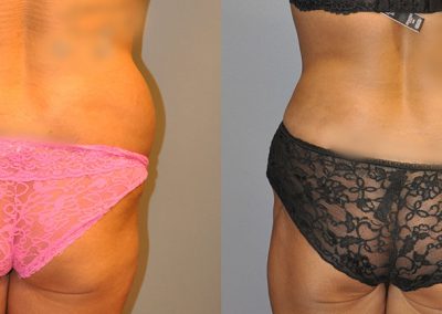 Enhanced silhouette: Before and after Liposuction treatment