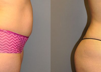 Before and after Liposuction: Visible transformation in body contours