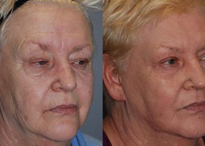 Before and after skin tightening with J-Plasma technology