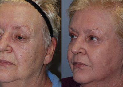 Youthful skin restoration: J-Plasma technology's transformative effects