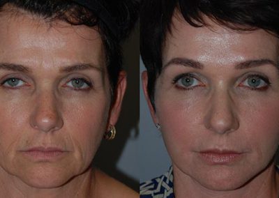 Enhanced skin rejuvenation: Before and after J-Plasma transformation
