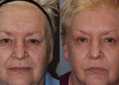 Before and after J-Plasma treatment: Transformational results