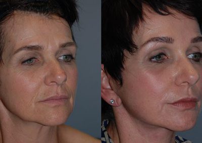 Helium plasma transformation: Before and after J-Plasma procedure