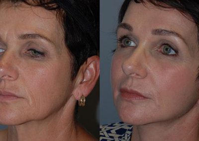 J-Plasma technology: Visual comparison of pre and post-treatment