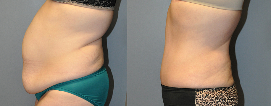 bariatric-body-after-weight-loss-before-and-after-barr-plastic-surgery-sudbury-ontario-5