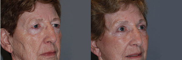 Enhancing eye contours: Eyelid surgery procedure