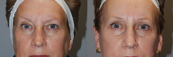 Sculpting rejuvenated eyes: Eyelid surgery in progress