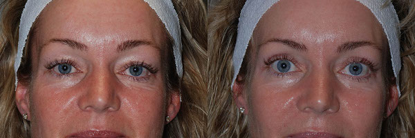 Artful precision in eyelid surgery