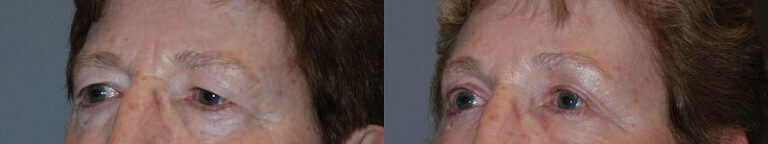 Crafting rejuvenated expressions: Brow lift surgery