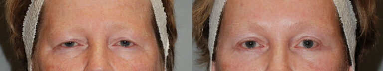 Sculpting youthful brows: Brow lift transformation