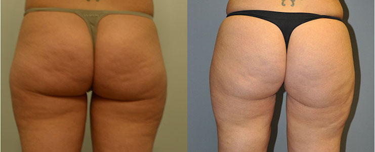 Crafting flawless contours: Cellulaze procedure