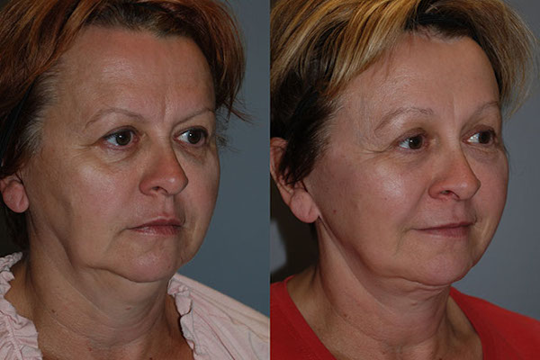 Facial renewal in progress: Face lift procedure