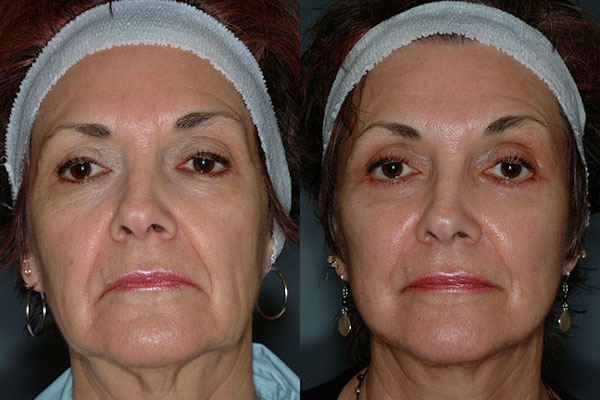 Artful refinement: Face lift surgery in action