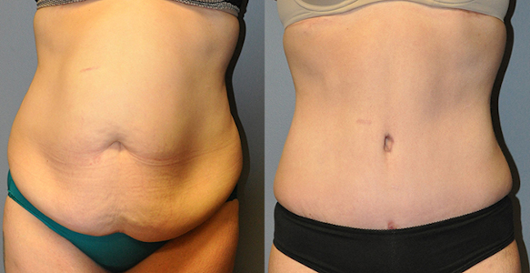 Body Contouring After Weight Loss - Fort Worth - Kirby Plastic Surgery