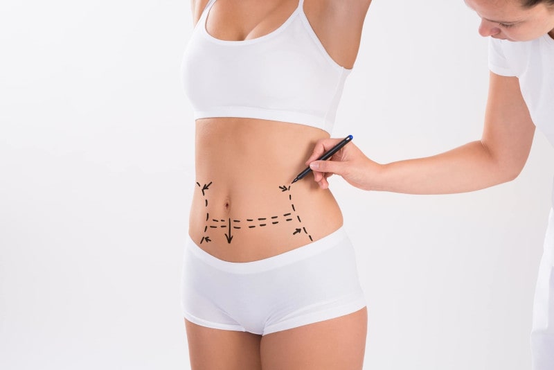Considering Abdominoplasty After Weight Loss