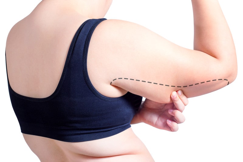 Body Contouring After Weight Loss: Arm Lift Surgery