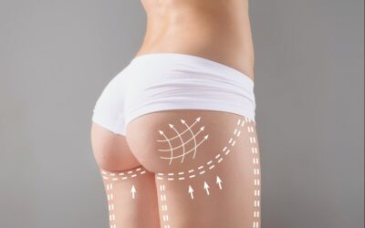 The Complete Guide to Buttock Lift Surgery: What You Need to Know