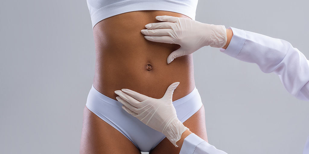 Tummy Tuck Before and After Photos Toronto, Ontario CA
