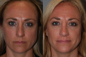Septorhinoplasty