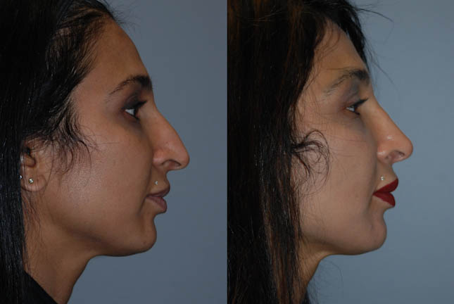 Septorhinoplasty