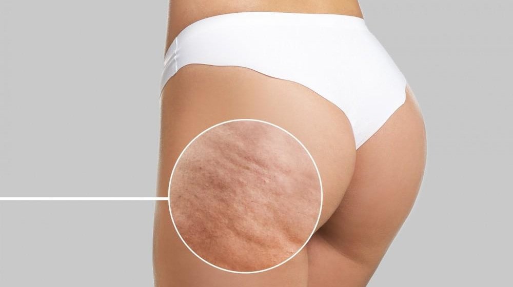 cellulite treatment cellulite treatment
